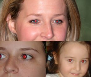 How to Get Rid of Red Eye Effect